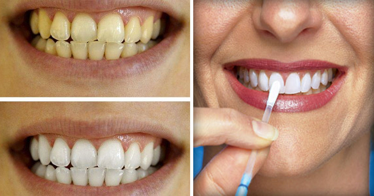 Tratamiento para blanquear los dientes y tener una sonrisa 